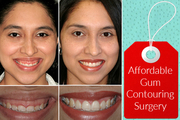 Experienced Cosmetic Dentist in Glasgow for Gum Contouring Surgery